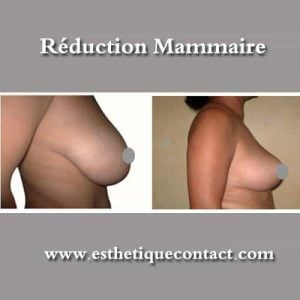 reduction mammaire en Tunisie