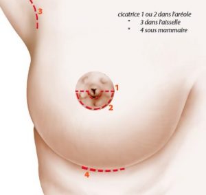 les différentes cicatrices de prothèses mammaires